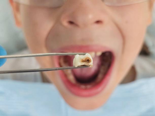 Best Emergency Dental Care for Broken or Chipped Teeth in Hazel Green, AL